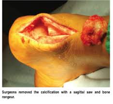 Calcaneal Spur