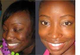 Skin Lightening Cream Before After