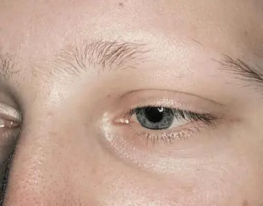 Eyebrows Falling Out, Causes, hair Loss, not growing Back, Male, Stress