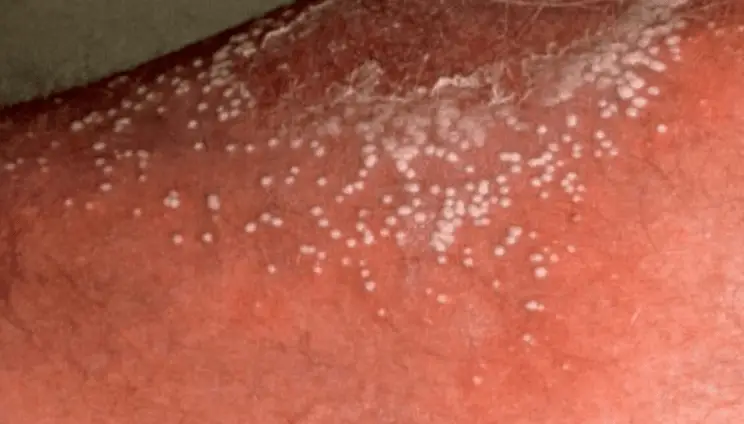 White Spots On Legs Dry Spots Itchy Blood Circulation Thighs 