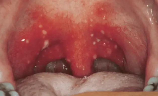 White Spots On The Back Of Throat 48