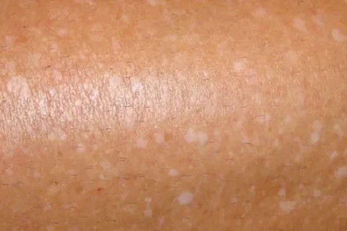 White Spots On Body Causes Small Sun Fungus Tanning Legs Cancer