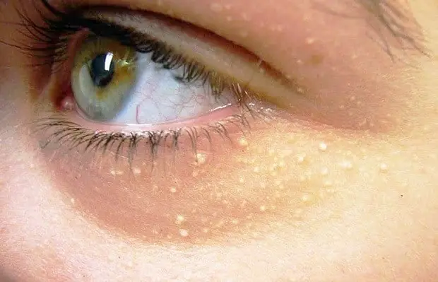 White Spots Under Eyes Little Not Milia Pictures Cholesterol 