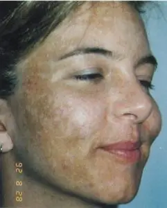 How white patches looks on the face