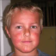 Symptoms of sun poisoning in children