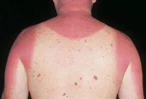 sunburn blisters on back