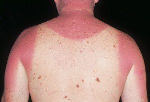 sunburn blisters on back