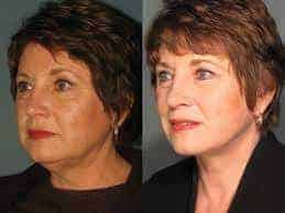 Before and after yosa facial toning exercises