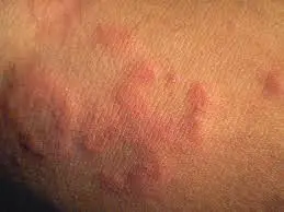 Chronic hives appearance on the skin