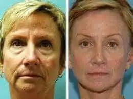 Facial yoga exercises before and after picture
