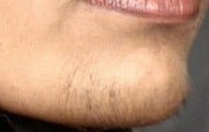 Female chin hair sprouting