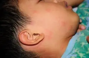 Hives symptoms in children