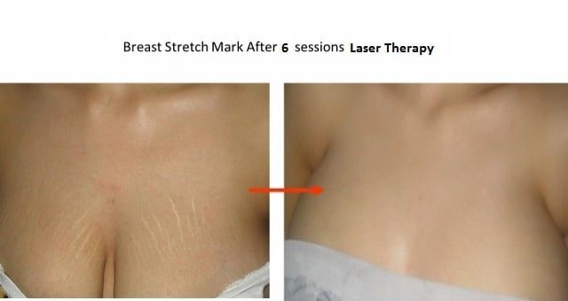 Laser Removal for Stretch Marks on Breasts