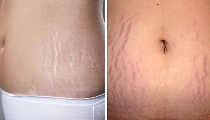 difference between Red Stretch Marks & White Stretch Marks