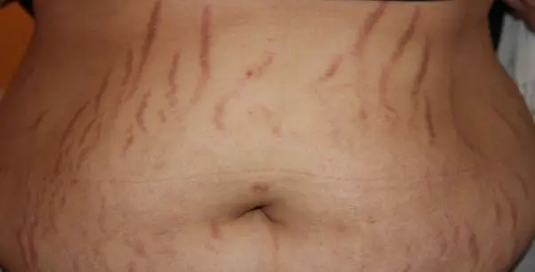 stretch marks on the stomach