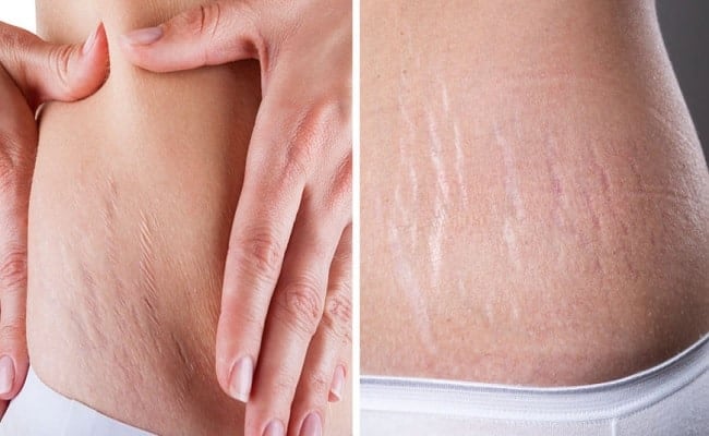 Stretch marks treatment