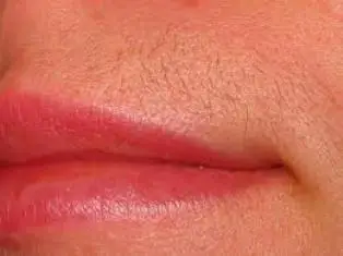 Upper lip hair removal