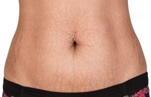 causes of stretch marks