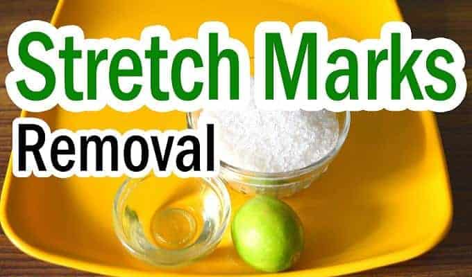 Home Remedies for Stretch Marks