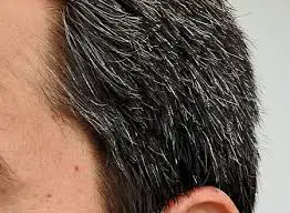 Gray Hair Cure and Treatment