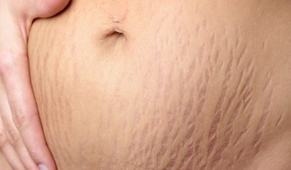 Causes Of Stretch Marks Definition Types Best Treatments And Home