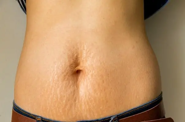 causes of stretch marks