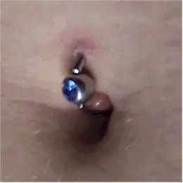 Belly button piercing keloids