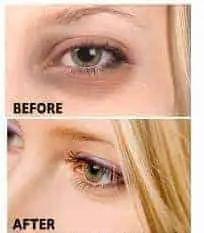 Dark circles under eyes removal cream before and after photo