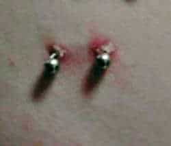 Infected navel piercing