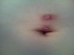 Navel piercing rejection
