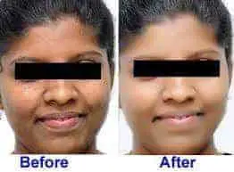 Skin whitening pills before and after picture