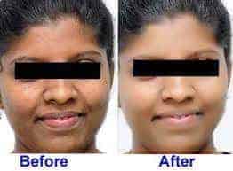 Skin whitening pills before and after picture