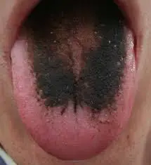 Black hairy tongue picture