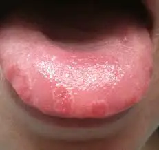 Brown spots on the tongue