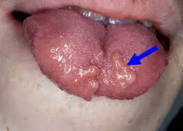 Bumps on the tongue showing an infection
