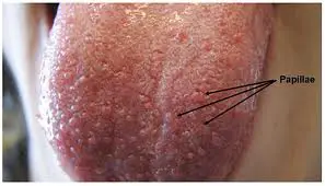 Bumps on tongue picture showing papillae