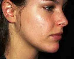 Dry skin rash on the face