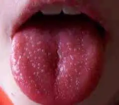 Red spots on the tongue