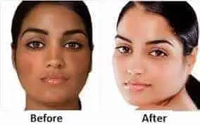 Skin bleaching before and after