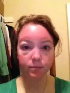 Sun poisoning swelling on face