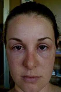 Sun poisoning swollen face