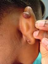 Infected Ear Piercing keloid