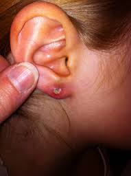 Infected Ear Piercing signs