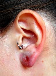 Infected Ear Piercing symptoms