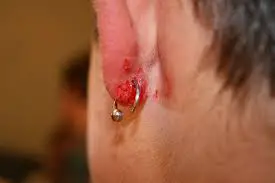 Infected Ear Piercing