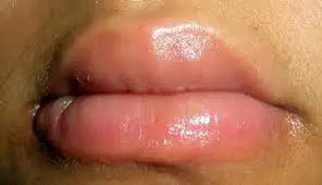 Signs of sun poisoning on lips