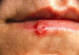 sun lips poisoning blisters symptoms treatment