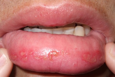 Symptoms of sun poisoning on lips