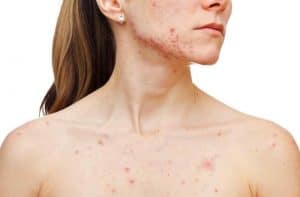 how to get rid of acne scars