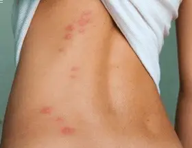 Symptoms of bed bug itch - reddish lesions